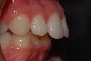 Denti sporgenti