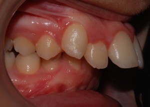 Effetti sulla crescita scheletrica e dentale della suzione del dito